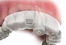 Imagem Categoria Endoguide (Endodontia Guiada)